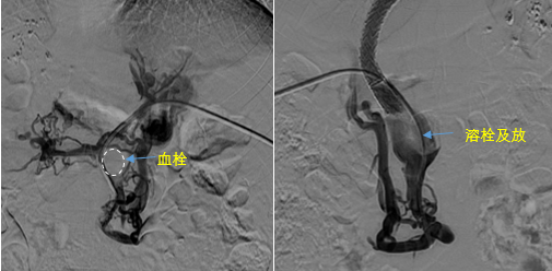 血栓攔路，如何破局——罕見巨大門靜脈血栓TIPS手術(shù)實(shí)錄