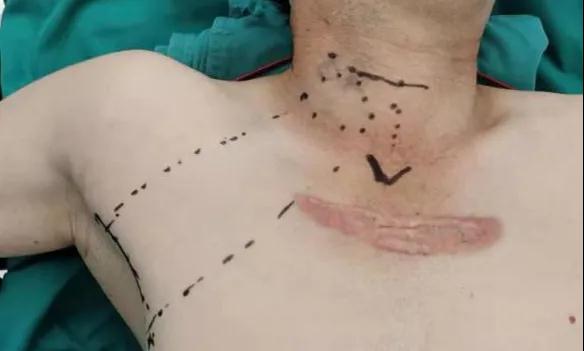 術(shù)后傷口可以“隱身”嗎？