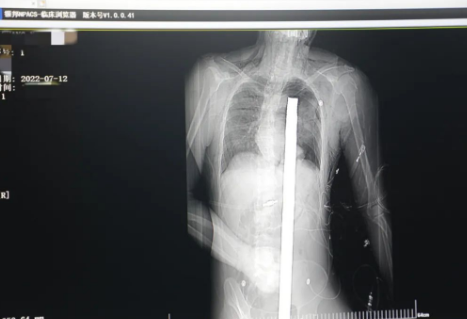 1.2米長的鋼筋貫穿男子胸腹！情況極度危險......