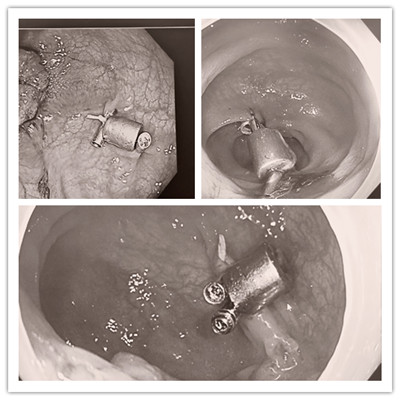 消化病醫(yī)院內(nèi)外科聯(lián)合開展3例“磁環(huán)預(yù)標(biāo)記輔助腹腔鏡結(jié)、直腸癌根治術(shù)”