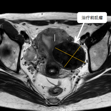 保子宮、保留生育功能—磁波刀治療子宮肌瘤