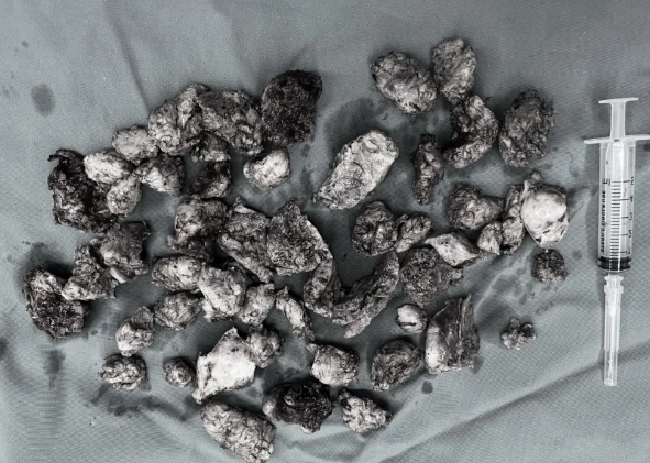 大腦一半是腫瘤 13歲少女在醫(yī)生助力下勇闖生命難關(guān)