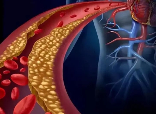 警惕！冠脈支架術(shù)后這些誤區(qū)千萬別踩，趕緊收藏！