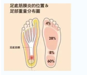 每年新生數(shù)百萬足底筋膜炎患者！國際醫(yī)學(xué)專家提醒：跑步要選擇合適的鞋