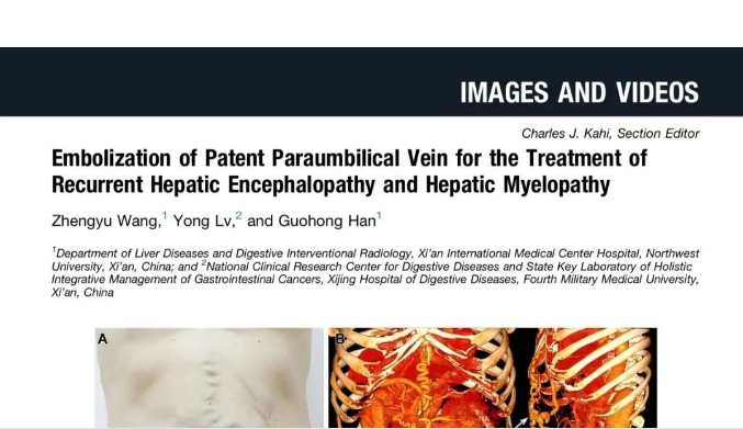 我院護(hù)理團(tuán)隊臨床成果登榜國際肝病權(quán)威期刊，影響因子11.6
