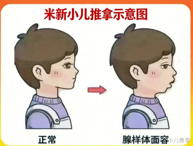 兒童腺樣體肥大只能手術(shù)？不，一位媽媽的親身經(jīng)歷給出另一種答案